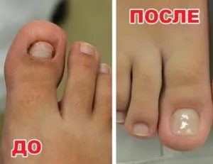 як лікувати нігті після грибка
