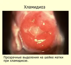 хламідіоз