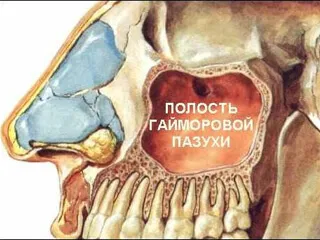 верхньощелепної синусит одонтогенний двосторонній