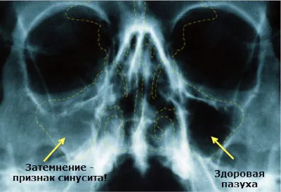 хронічний нежить заразний