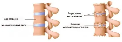 як лікувати хондроз під лопаткою