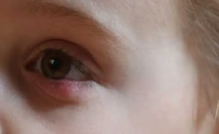 як лікувати халязион у дитини без операції