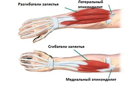 лікувати ліктьовий суглоб
