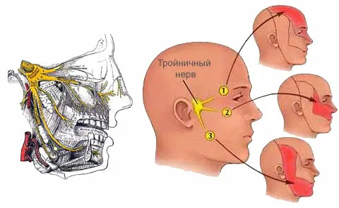 як лікувати невралгію лицьового нерва в домашніх умовах