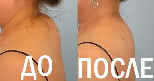 чи можна лікувати шию