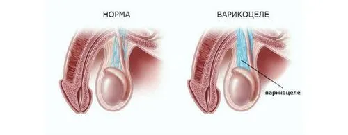 Важливе батькам: правда про варикоцеле у підлітків варикоцеле у підлітка лікування
