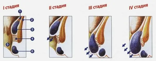 виліз геморой що робити