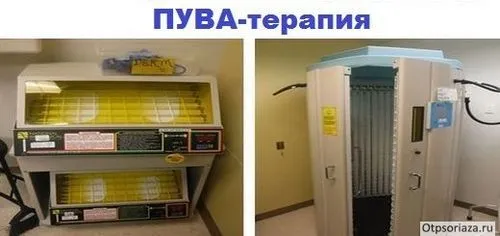 як лікувати поширений псоріаз