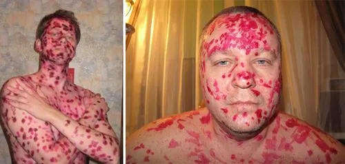 лікувати вітрянку дорослому