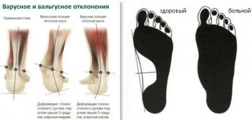 Варусна деформація стопи у дітей: корекція і лікування варусна деформація стопи у дітей причини лікування симптоми корекція діагностика