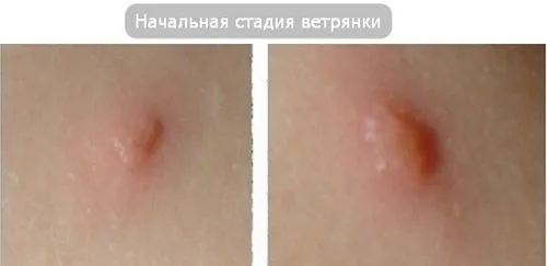 вітрянка у дитини симптоми