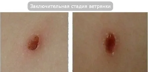 лікування вітрянки