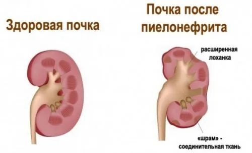 як лікувати запалення нирки