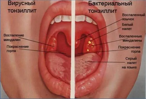 вірусний тонзиліт симптоми лікування чому відмінності бактеріальний у дітей