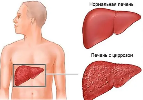 як вилікувати варикозне розширення вен стравоходу