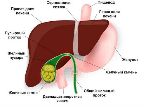 як лікувати холецистит без каменів