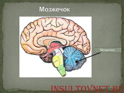 як лікувати інсульт мозочка