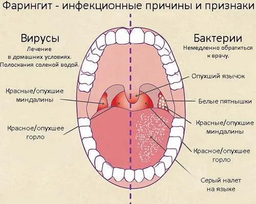 фарингіт тонзиліт лікування відрізнятися чому відмінність