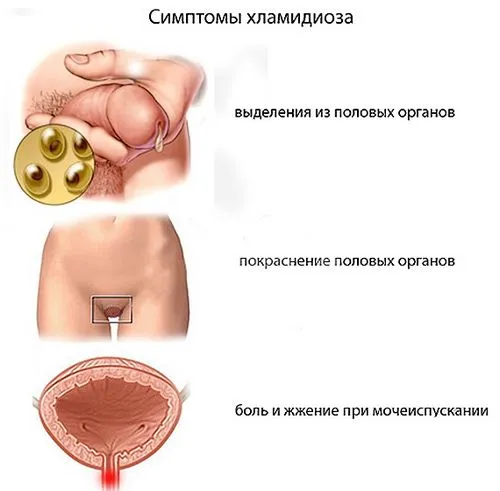 як лікувати хламідіоз уреаплазмоз