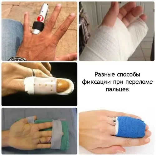 як лікувати розтягнення пальця руки