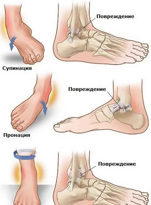 як лікувати розтягування і вивихи