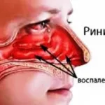 хронічний нежить заразний