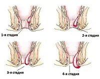 як лікувати хронічний геморой 2 ступеня