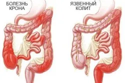як лікувати хронічну діарею