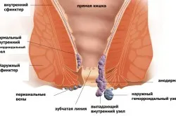 вилікувати хронічний геморой