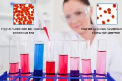 як довго лікувати залізодефіцитну анемію