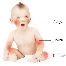 як вилікувати алергію на шампунь