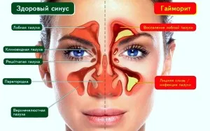 хронічний гайморит в стадії загострення