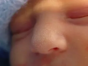 як лікувати жировики на обличчі у дитини