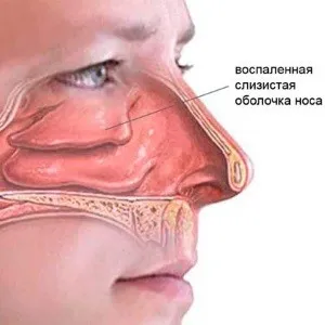 синусит
