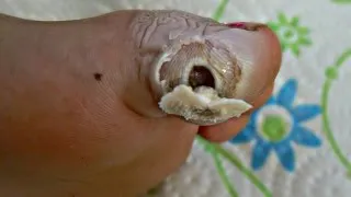 як лікувати жировик на руці