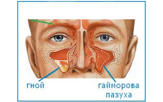 як лікувати жовтий нежить