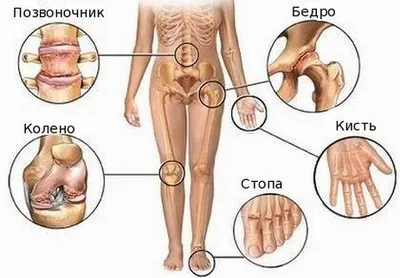 хрускіт в суглобах лікування народними засобами причини