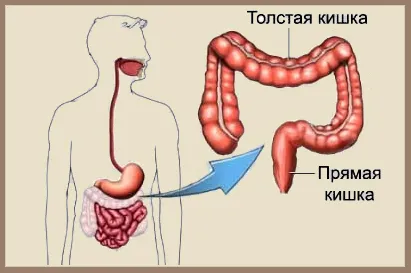 Хронічний запор лікувати хронічний запор