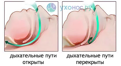 здоров'я як лікувати хропіння