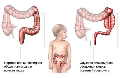 як лікувати запор у трирічної дитини