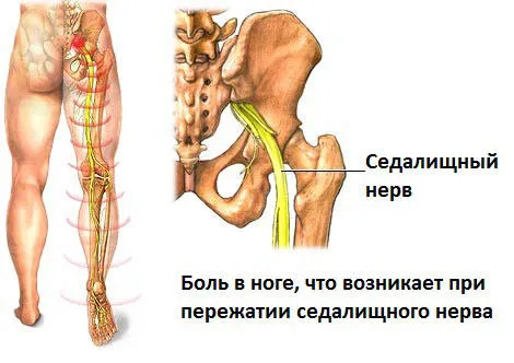 защемлення нерва в нозі