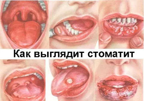 Виразки в роті (стоматит) - причини як вилікувати великий стоматит