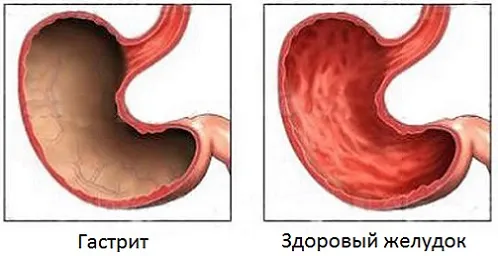 як лікувати закид жовчі в стравохід