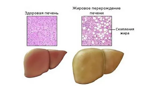 як лікувати дистрофію печінки