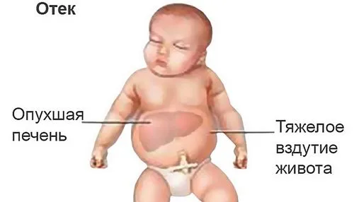 як лікують жовтяницю у дітей