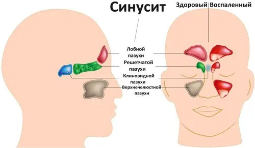 Хронічний синусит хронічний нежить синусит