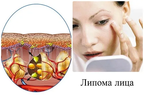 як лікувати жировики на тілі