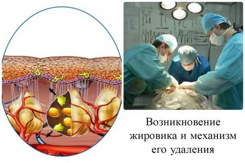 як лікувати жировики на обличчі у дитини