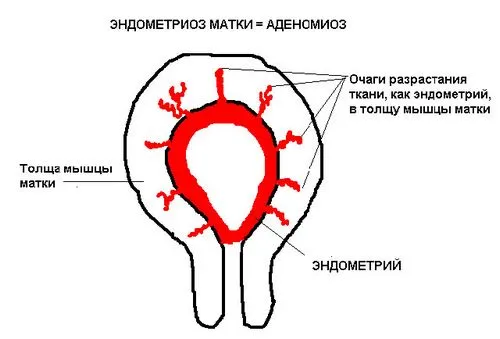 як лікувати вогнищевий ендометріоз