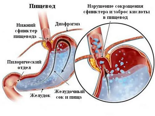 як лікувати печіння в шлунку